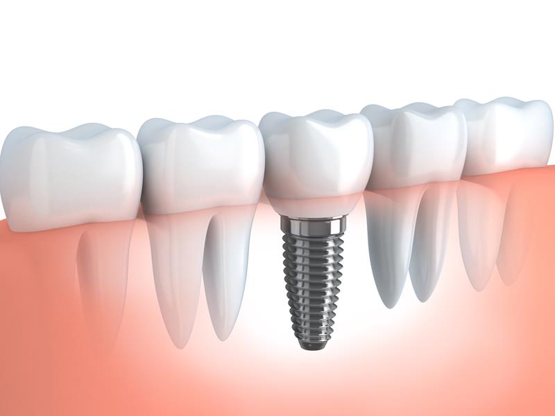 Dental Implants Linden, NJ